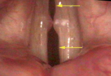 An air leak in the vocal cords, specifically a split gap.
