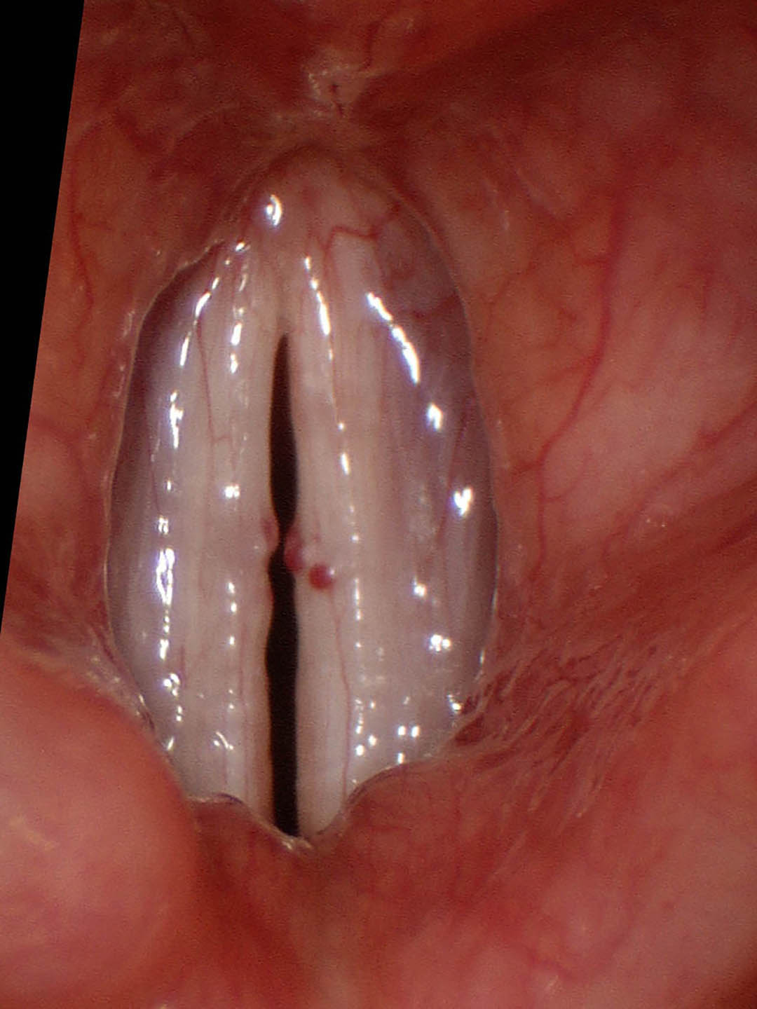 Bilateral hemorrhagic vocal cord polyps, multilobulated with dilated capillaries