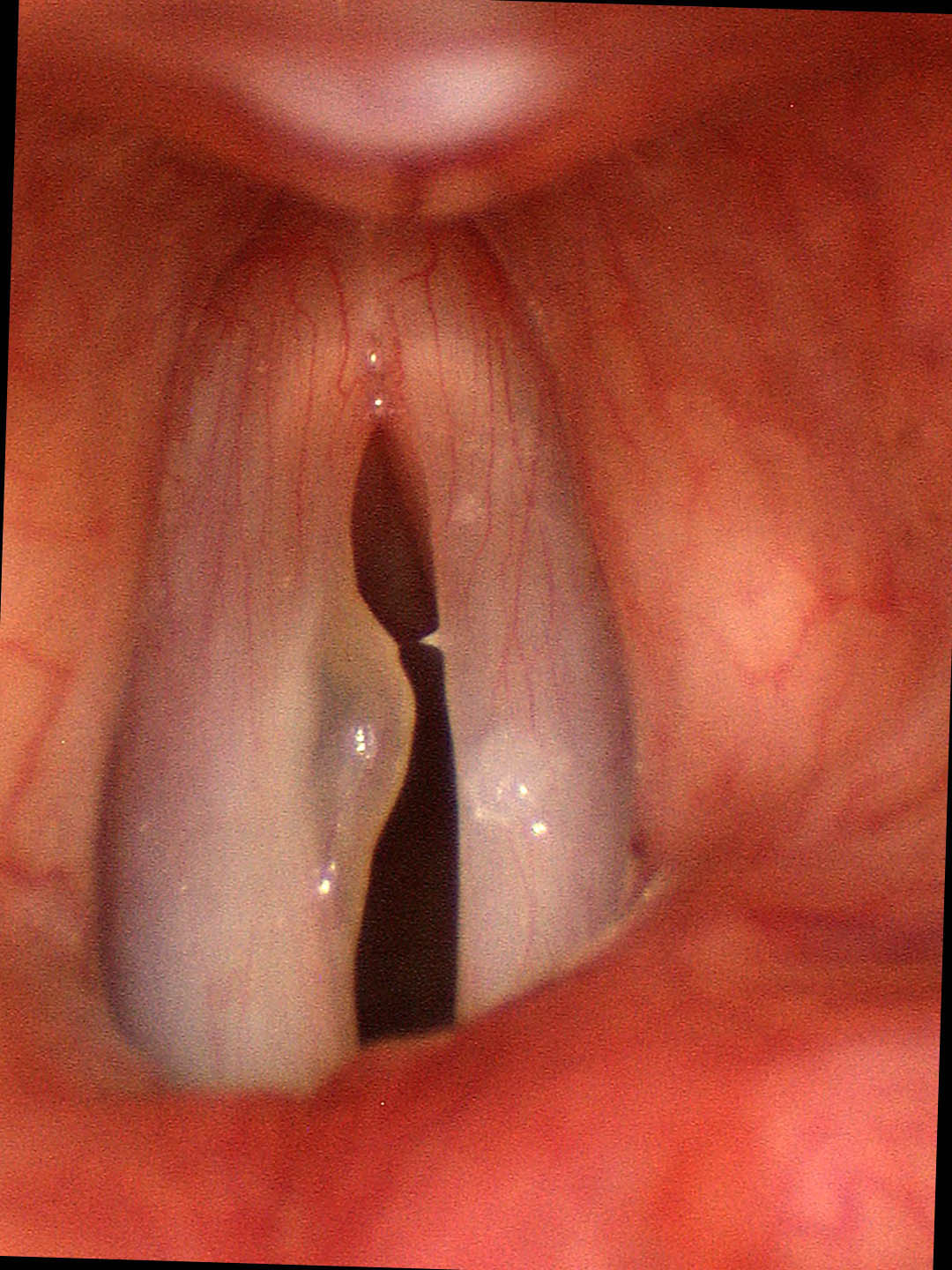 Left-sided hemorrhagic vocal cord polyp with internal ectatic capillary