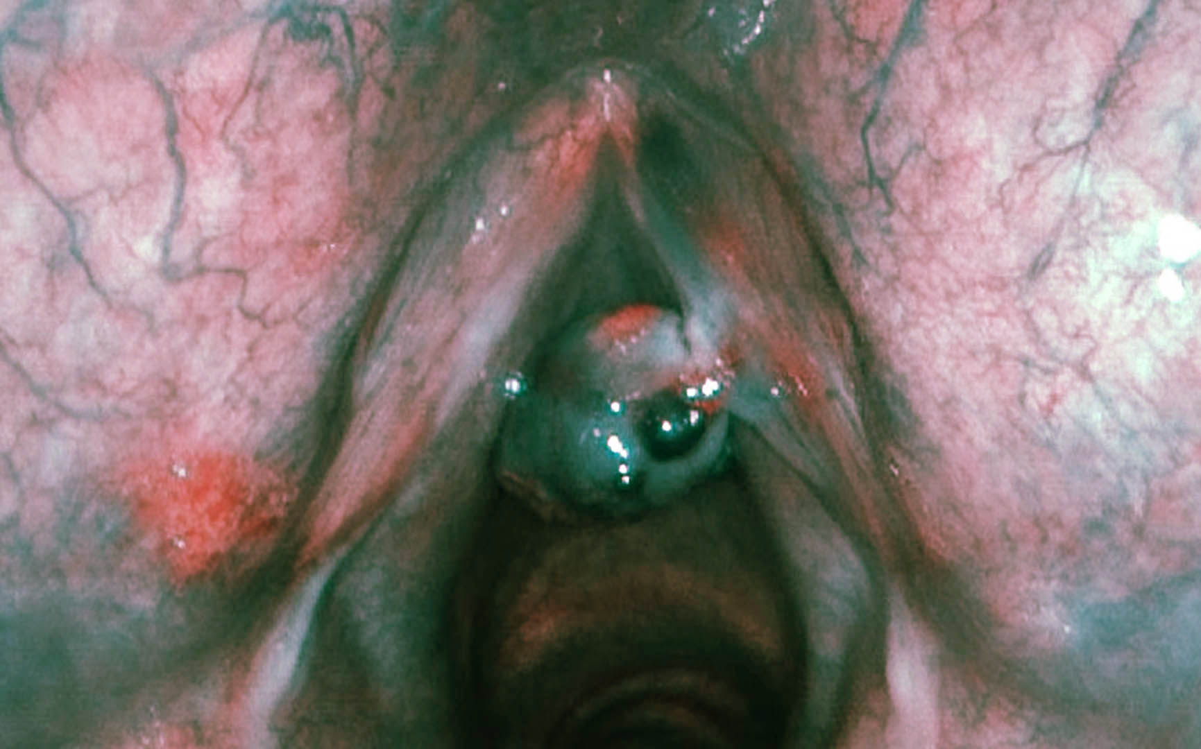 Large multilobulated hemorrhagic vocal cord polyp in abduction