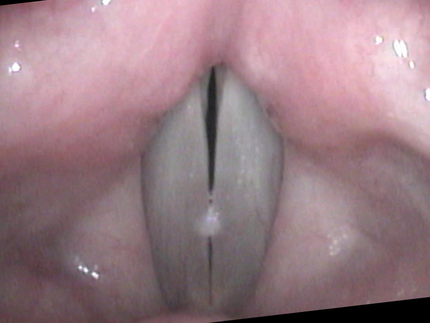 Mucus bridging across nodules