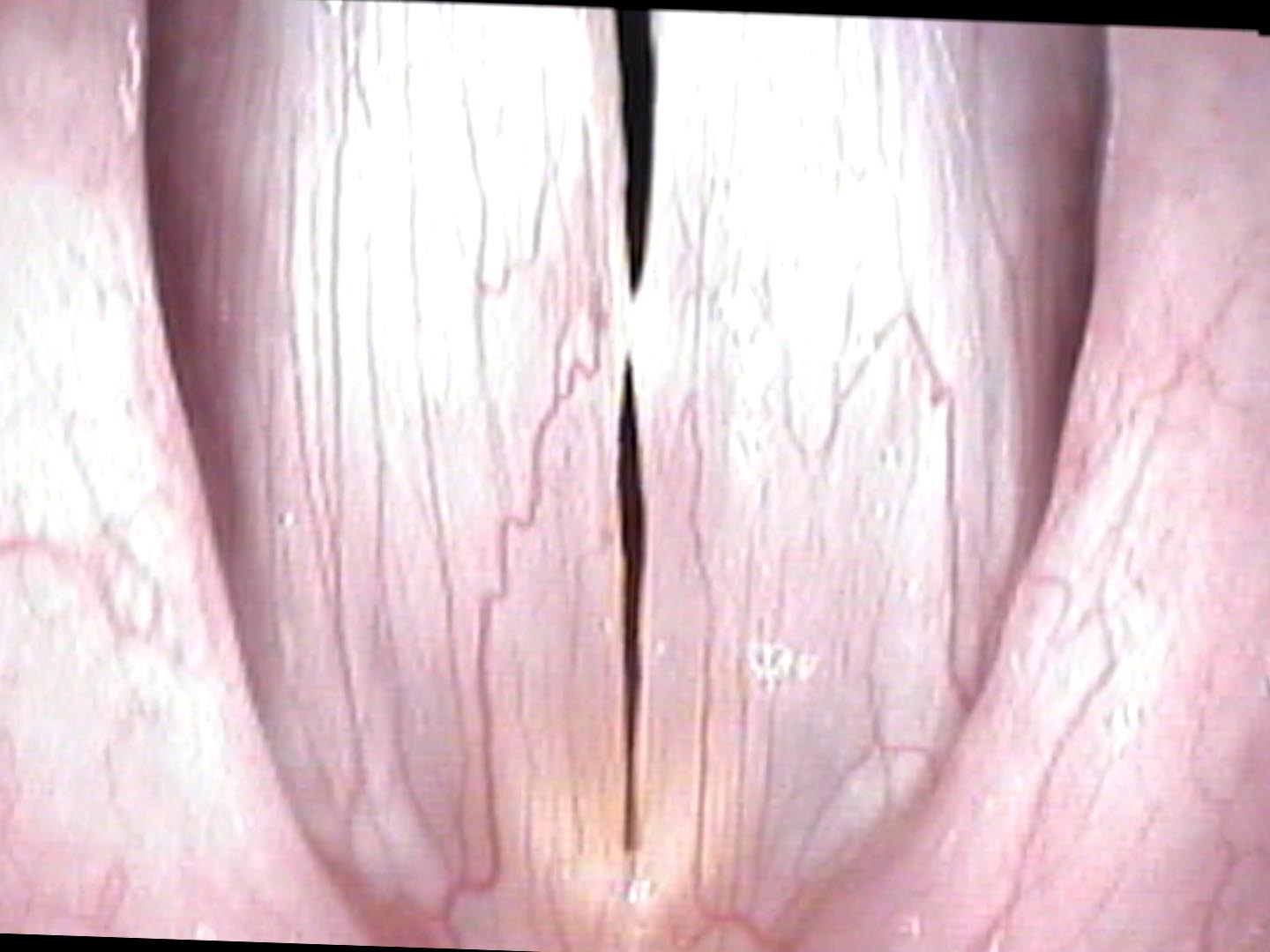 Diplophonia from large nodules