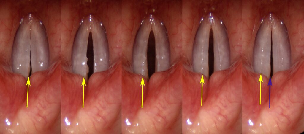 Normal vocal cord vibratory cycle, five-frame sequence