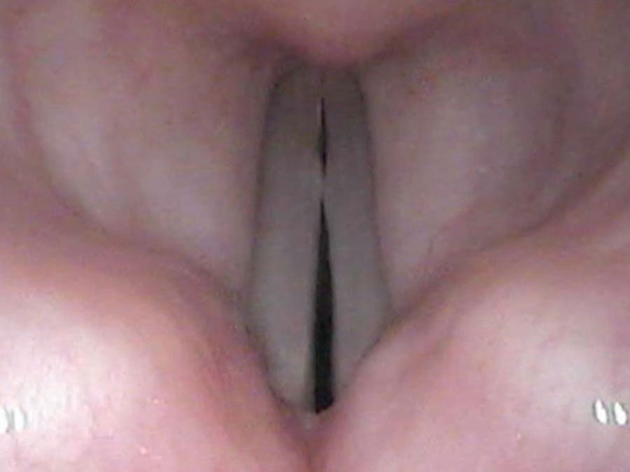 Bilateral vocal nodules at mid-cord