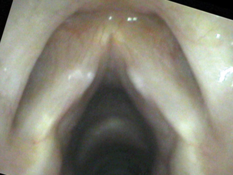 Nodule swelling test — low pitch