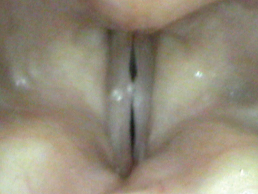 Nodule swelling test — higher pitch