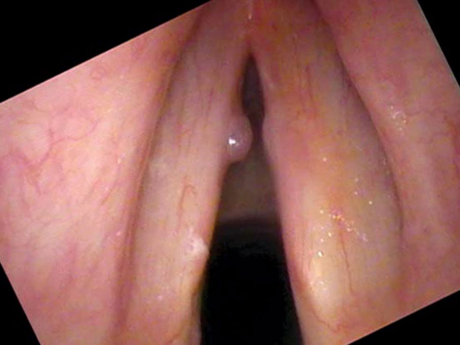 Unilateral hemorrhagic polyp with reactive contralateral swelling