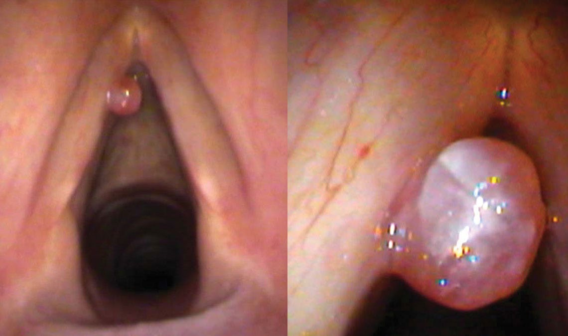 Recurrent polyp — close view showing stalk and feeding vessel
