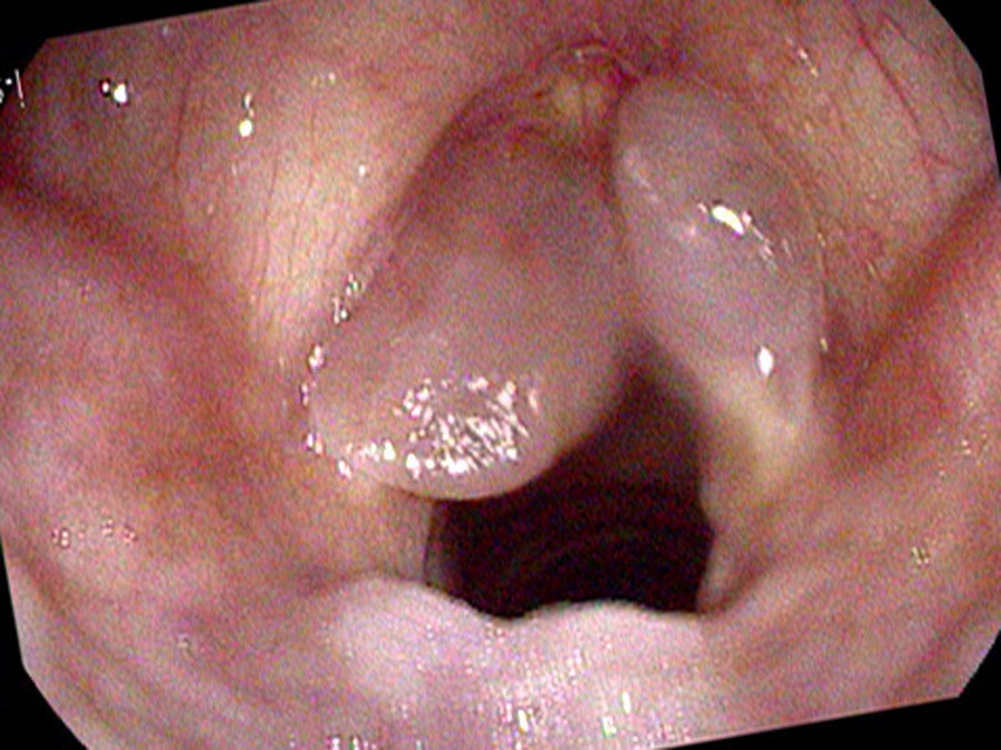 Smoker's polyps — angled view