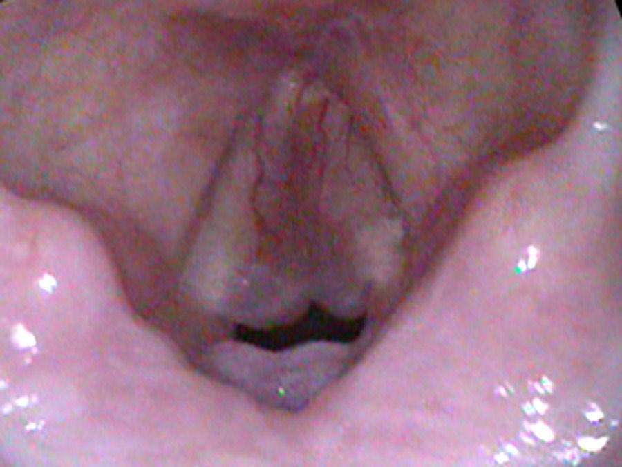 Polyps obstructing the airway on inhalation