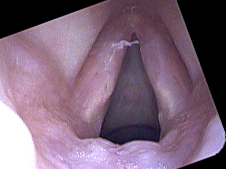 After partial excision and KTP laser treatment