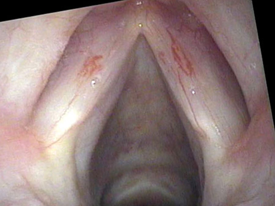 Tortuous capillaries in the mid-cord — historical record of overuse