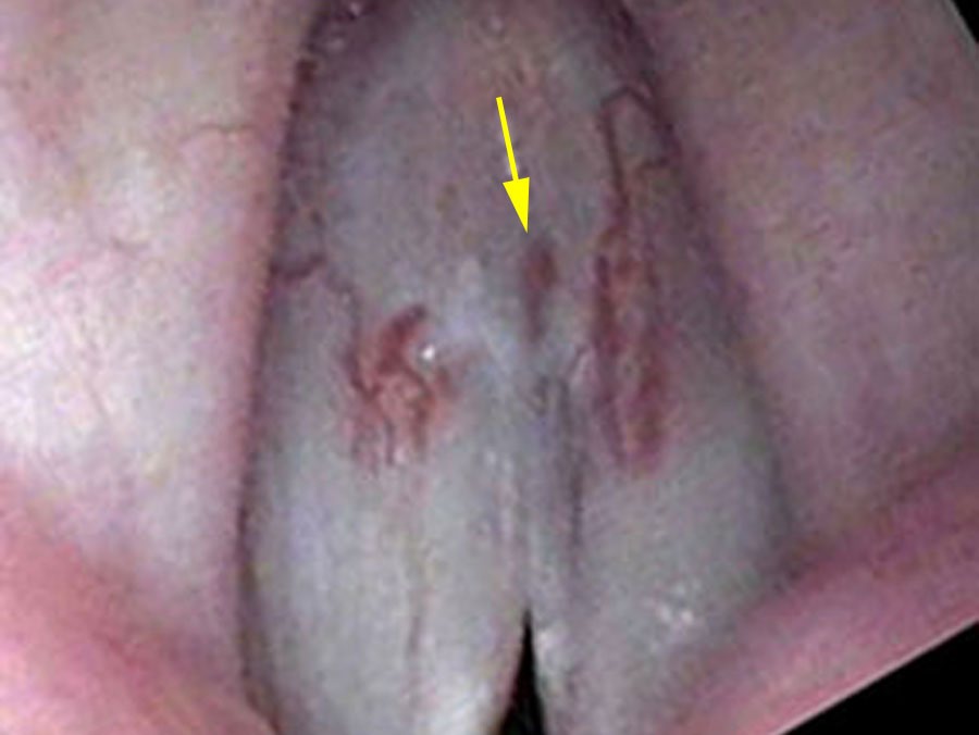 Edge capillaries visible during stroboscopic eversion