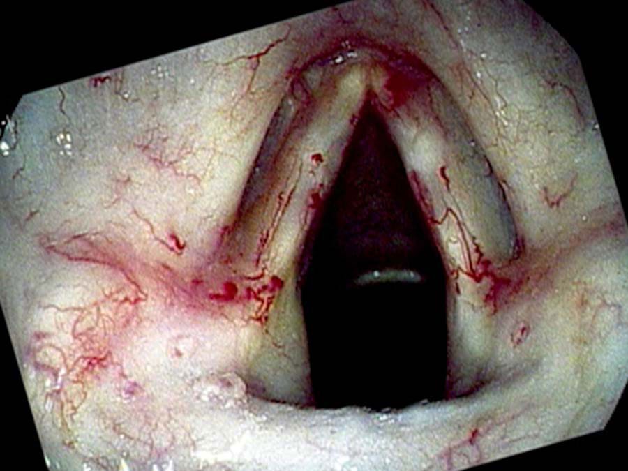 Radiation telangiectasias on true and false vocal cords
