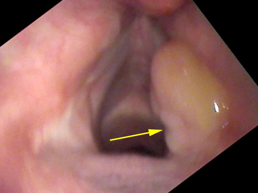 Large vocal process granuloma with underlying ulcer