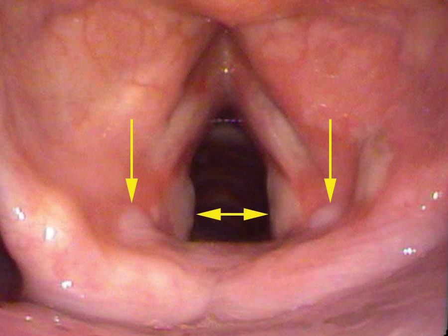 Four ulcers two days after intubation