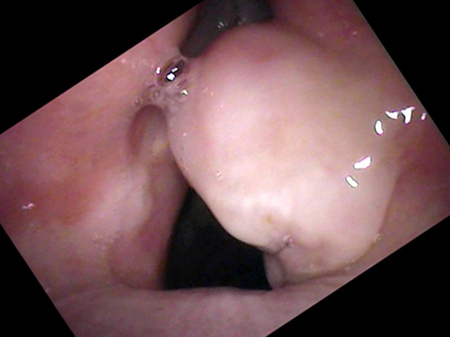 Mature granuloma on a stalk — white and smooth