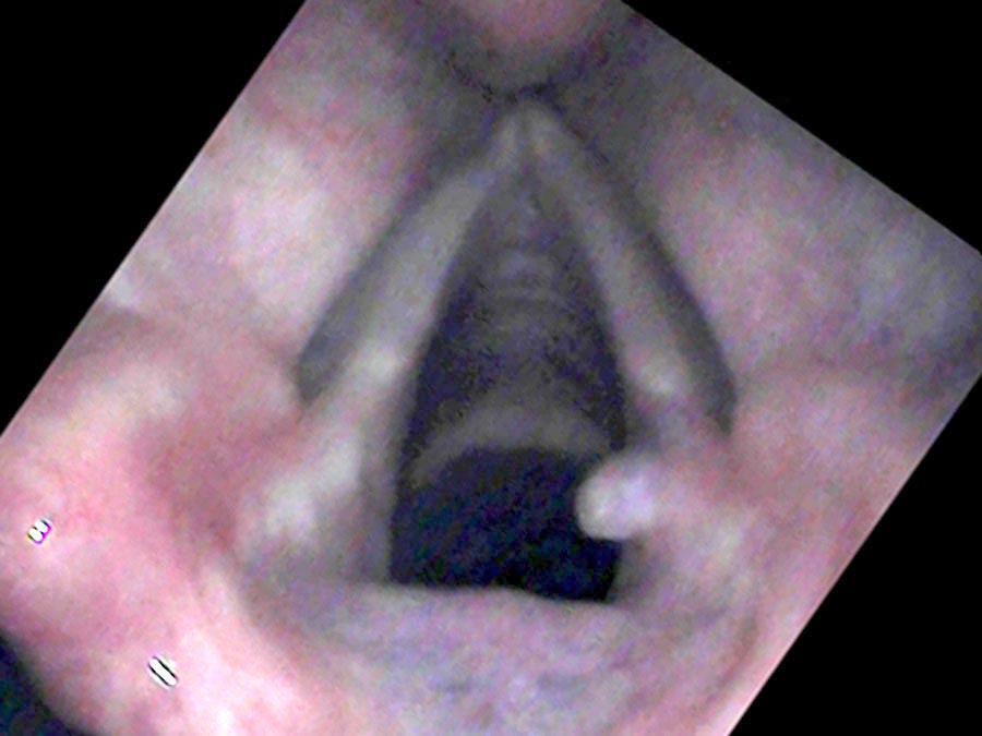 Granuloma reduced after treatment