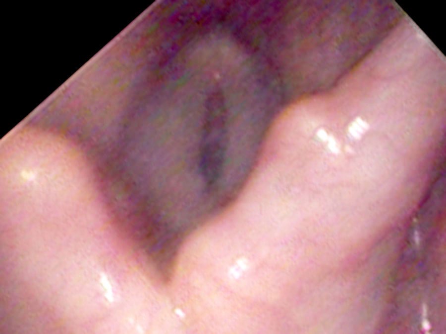 Bowed vocal cords — vocal processes striking each other at closure
