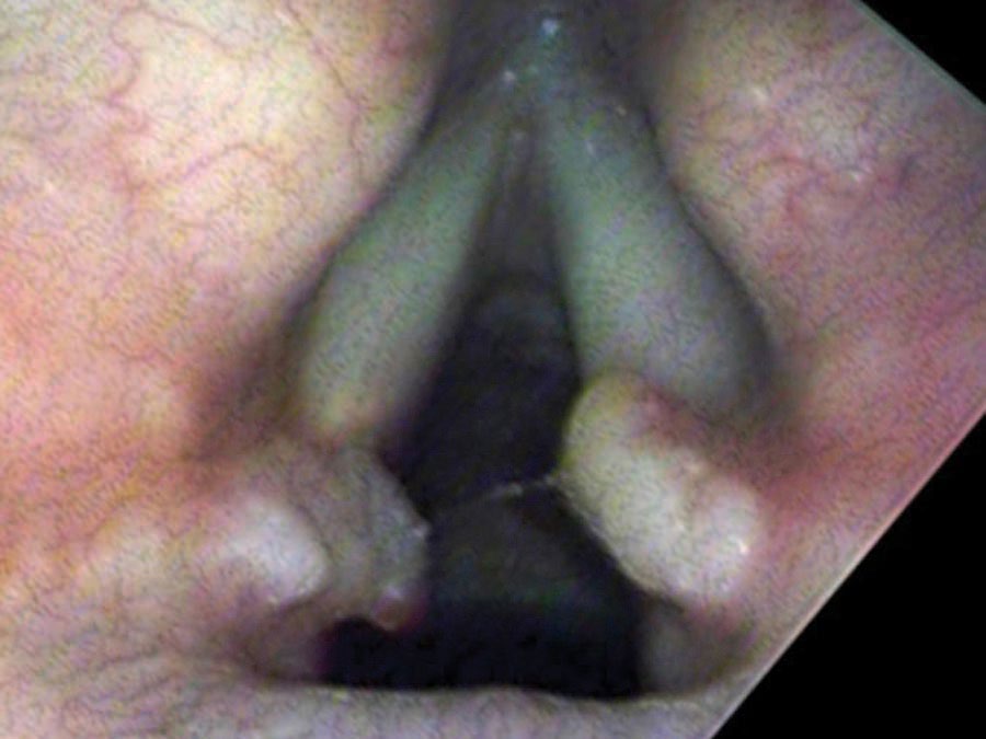 Healing stalk on left, new granuloma on right