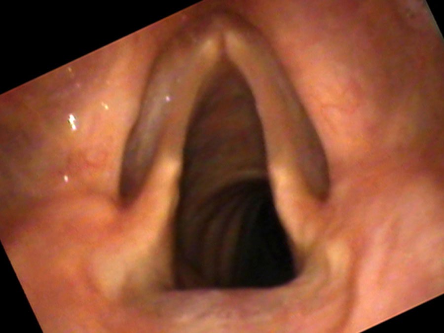 Three-dimensional muscle loss in vocal atrophy