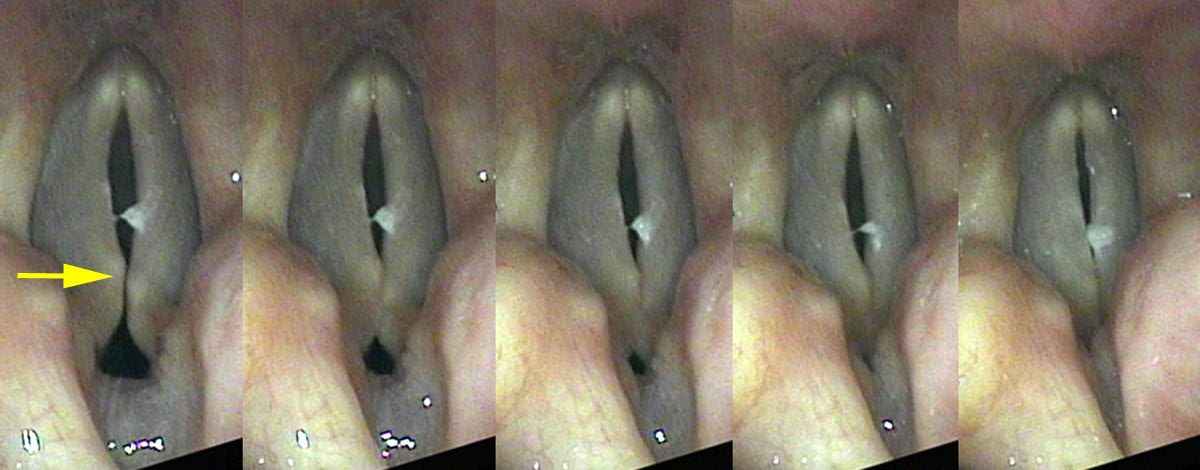 Scissoring compensation