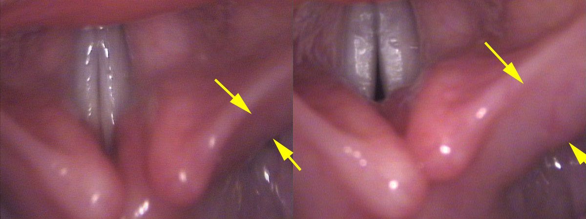 PCA muscle relaxed vs contracted — creating a posterior gap between the vocal cords