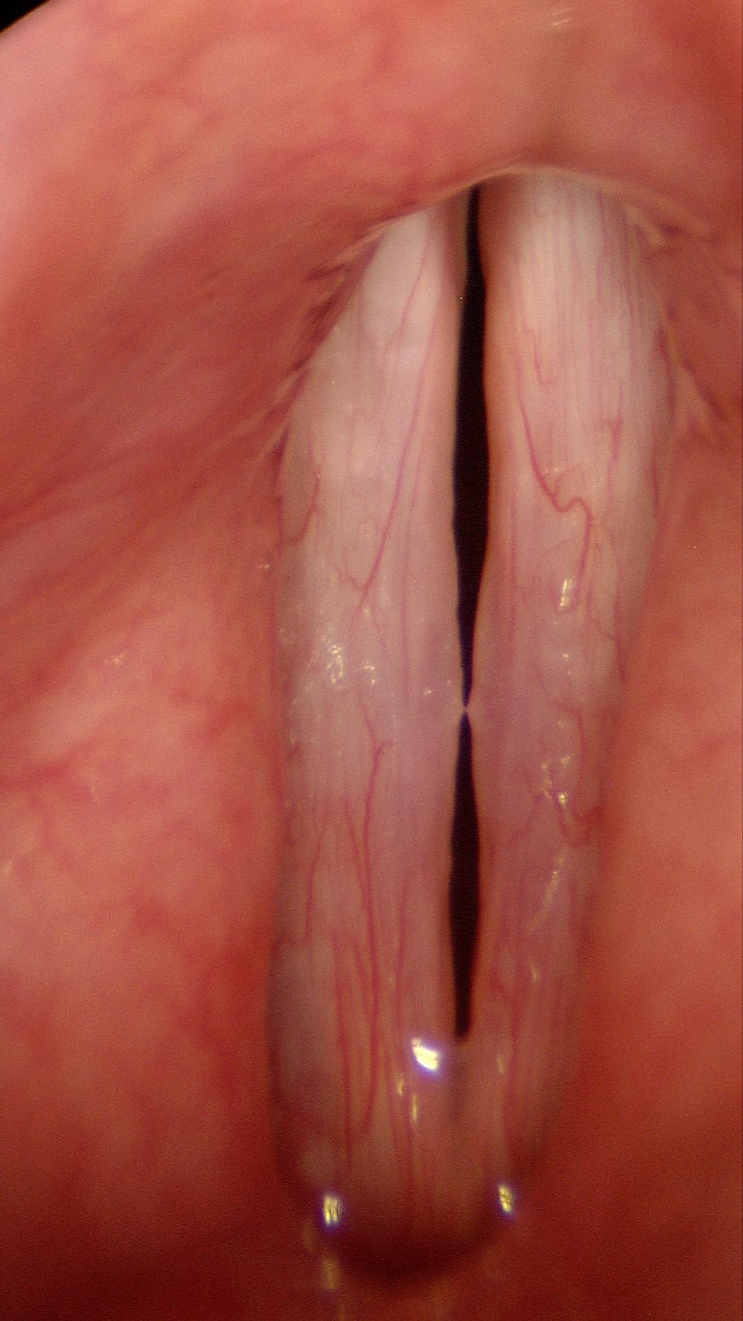 Vocal calluses, close view