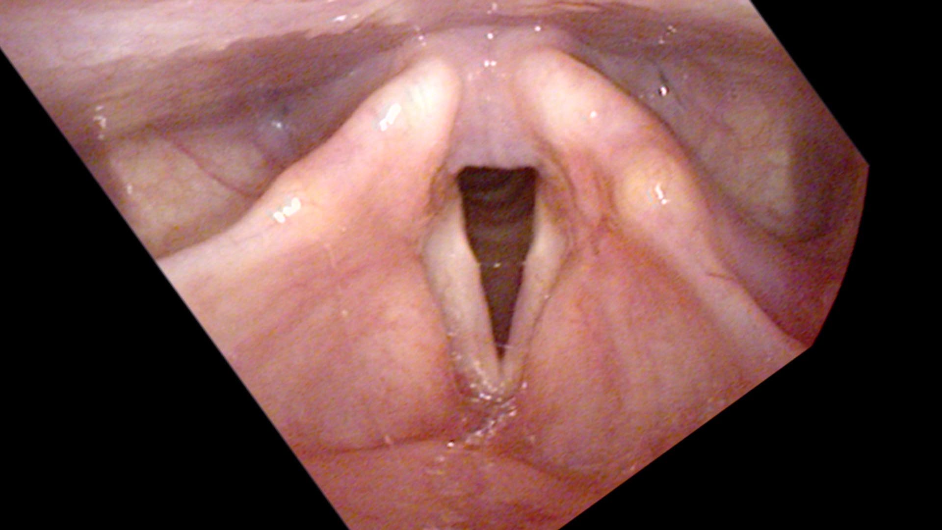 Vocal calluses, wider view