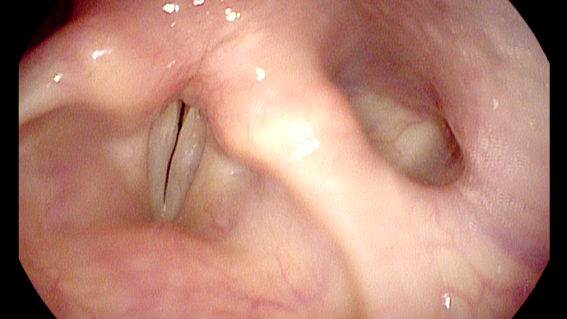 Vocal margins after treatment