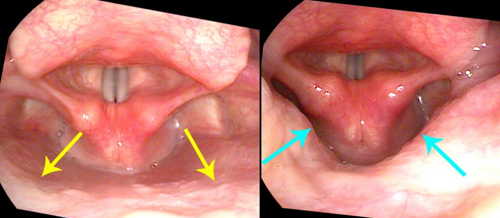Pharynx relaxed versus squeezed for resonance