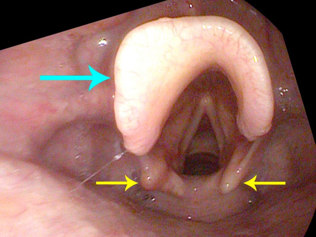 Epiglottis and vocal cords viewed endoscopically