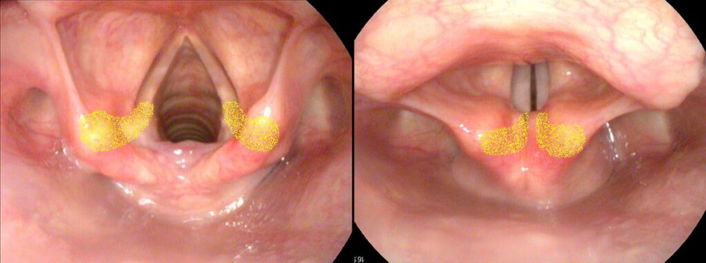 Arytenoids open and adducted for phonation