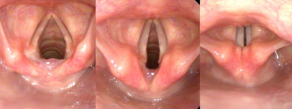 Vocal cord positions during breathing and phonation