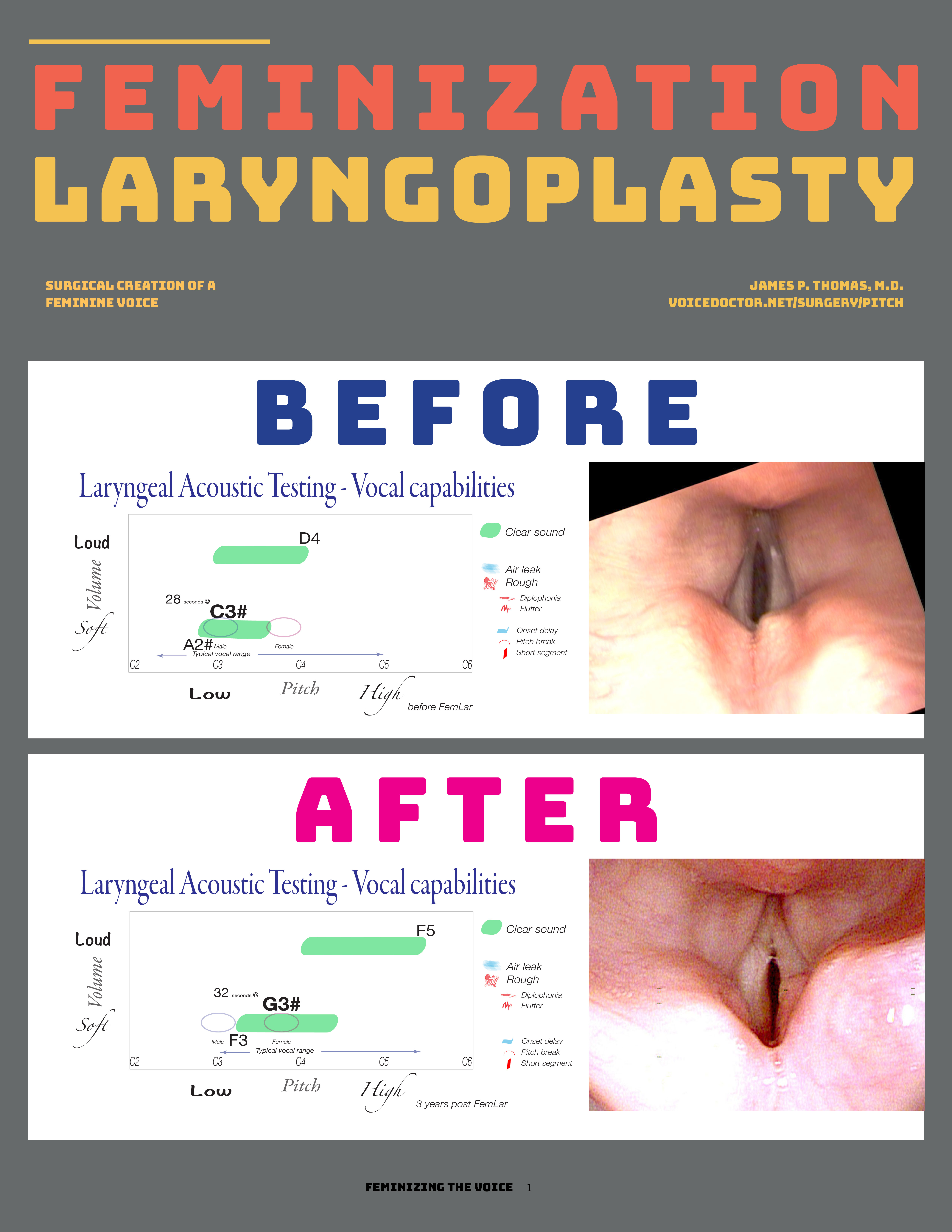 Feminization Laryngoplasty handout cover — click to download