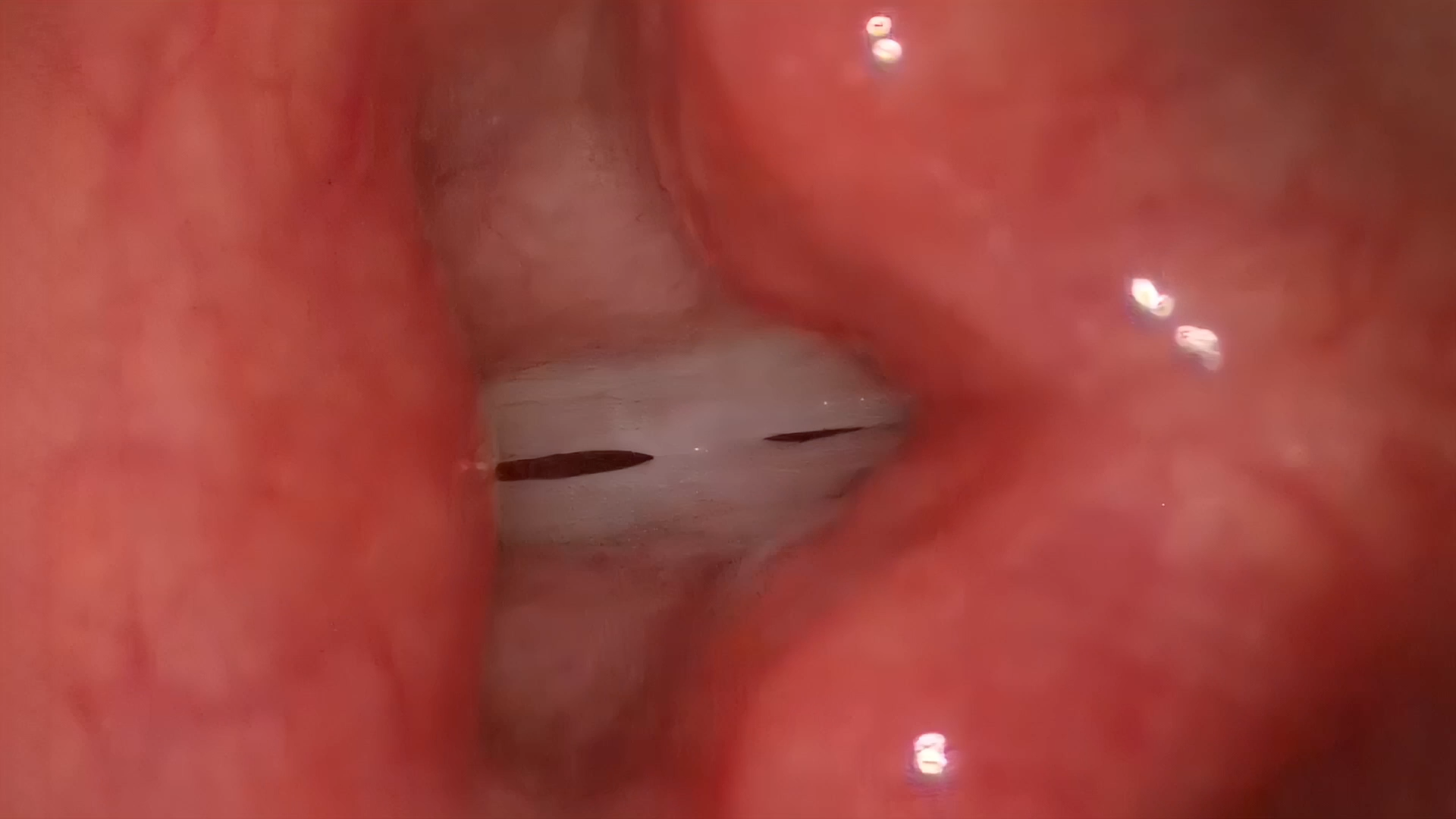 Figure 20.3 — Stroboscopic frame showing central polyp splitting vocal cords into two unequal vibratory segments