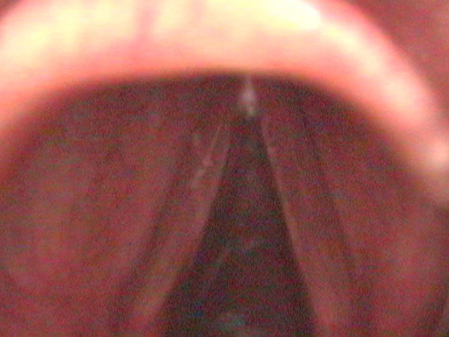 Acute infectious laryngitis — vocal cord blood vessels dilated, true cords nearly as red as false cords, secretions white and sticky