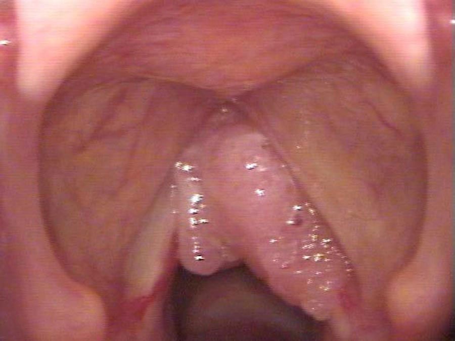 Papilloma — irregular lumpy mass on right vocal cord, biopsied in office at seven months pregnant