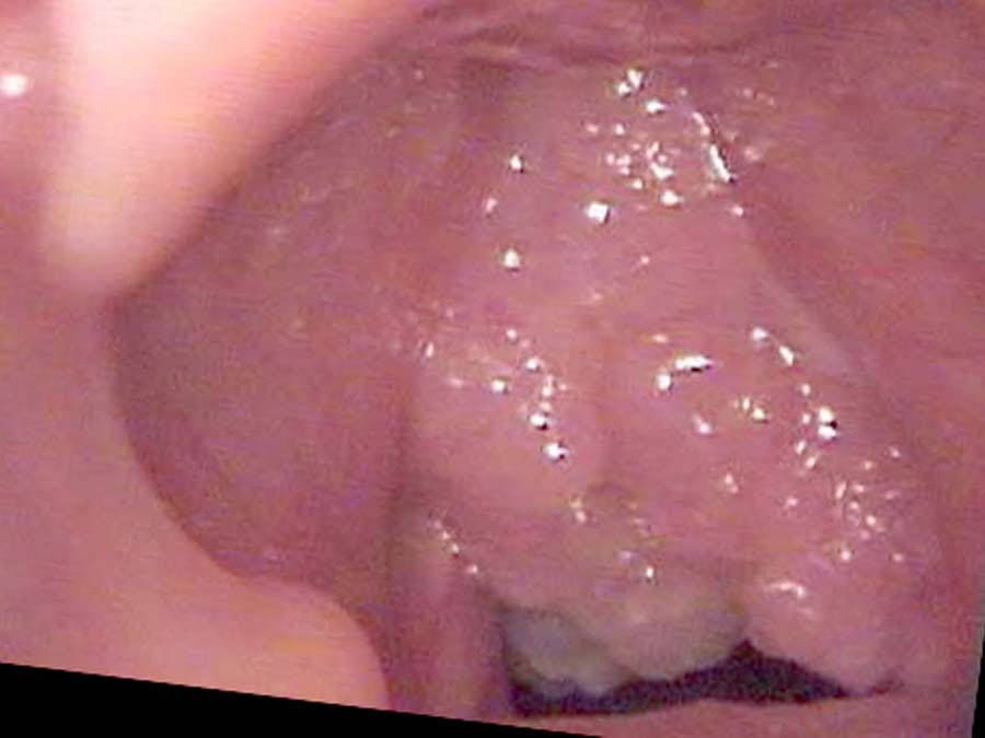 Papilloma three months later — grown to obscure most of the left vocal cord