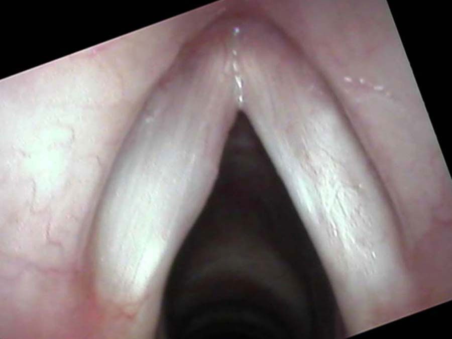High-definition endoscopic view of recurrent laryngeal papilloma with artificial color emphasizing blood vessels