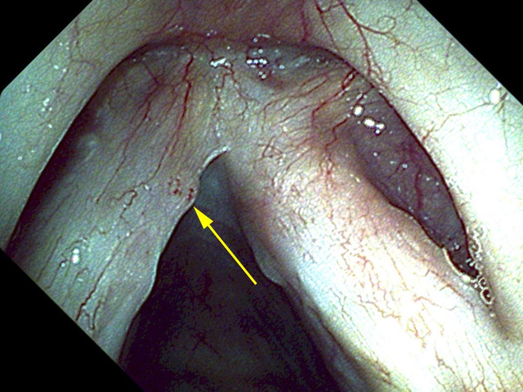 Eight years after third excision — left cord has callus, right cord has scarring but vibrates well