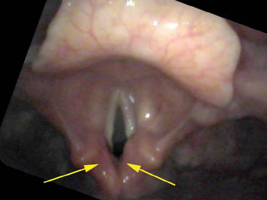 Interarytenoid area from distance — apparent redness from stacked capillaries, not reflux