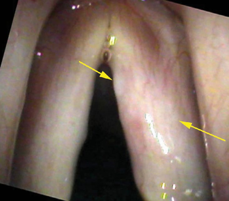 Within one millimeter of vocal cords — thin white film of fungus dimming the vessels