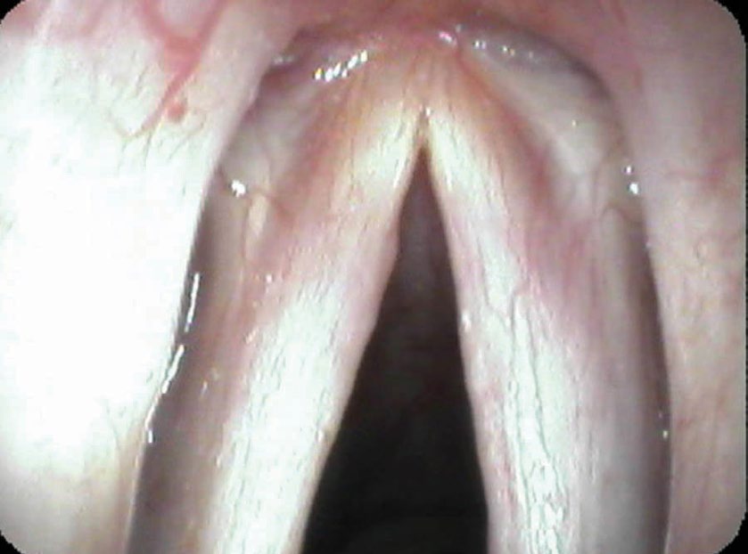 Vocal cords after treatment — vessels visible along full length, white film cleared
