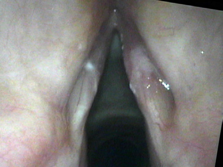 Cancer-like lesion from nasal steroid use — resolved completely within four weeks of antifungal treatment