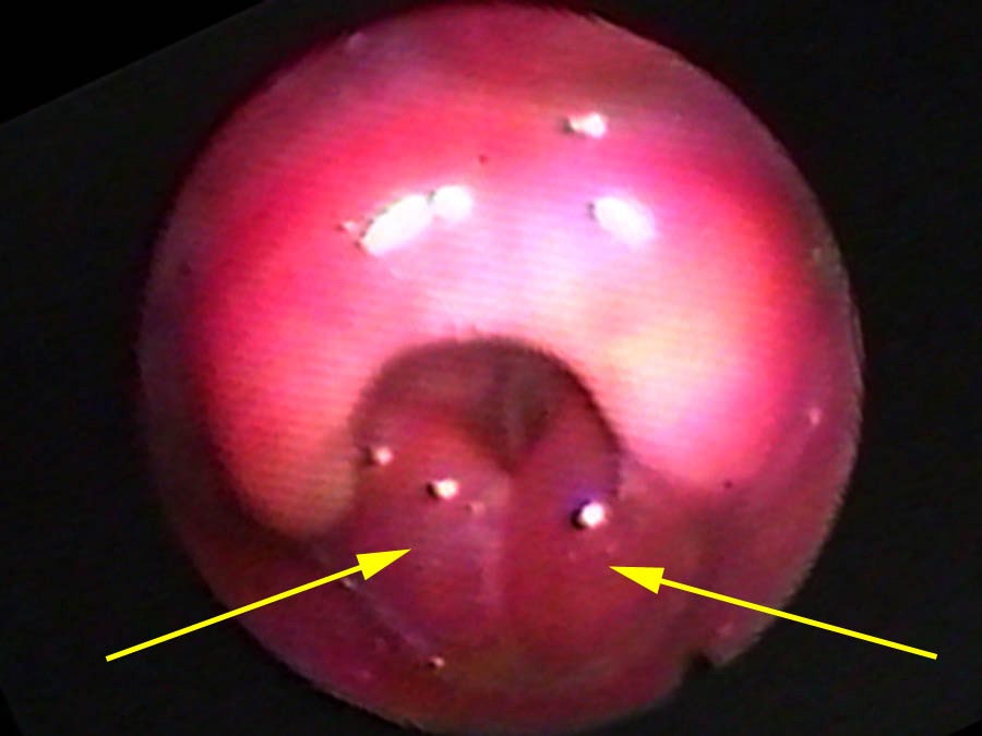 Supraglottitis — arytenoid swelling (arrows) pinching off the airway on inspiration