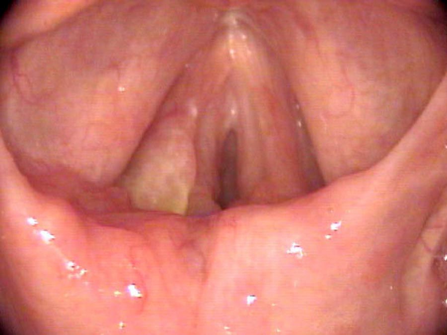 Coccidiomycosis growing on back of left vocal cord and into left arytenoid