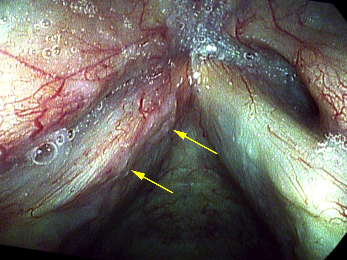 Tuberculosis on the left vocal cord margin (arrows)