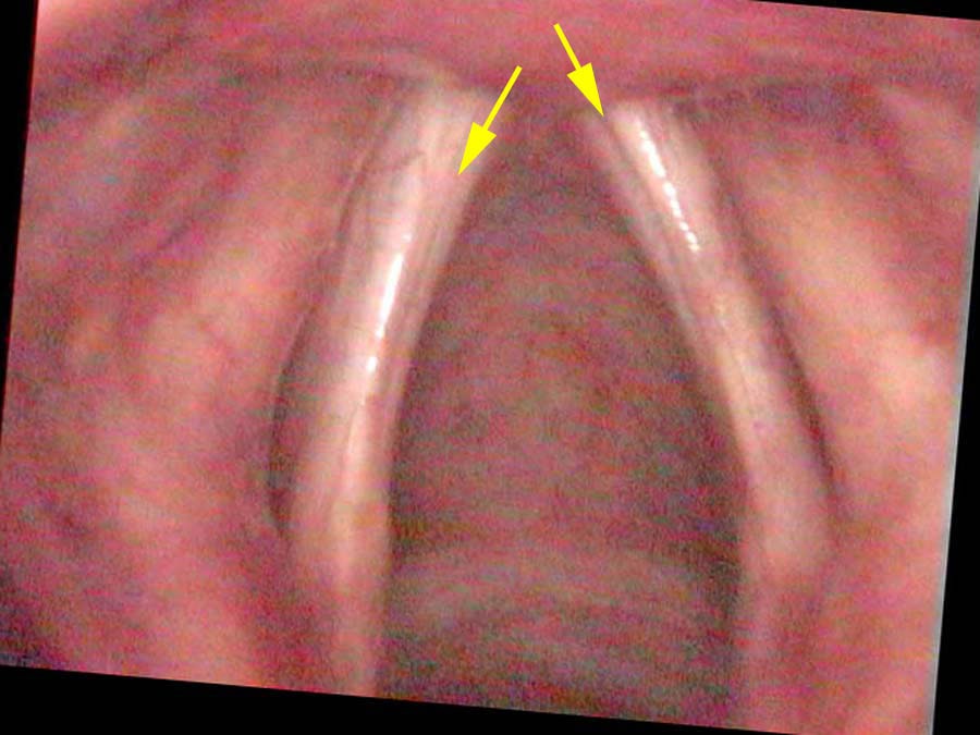 Arrows pointing to grooves in very atrophic vocal cords
