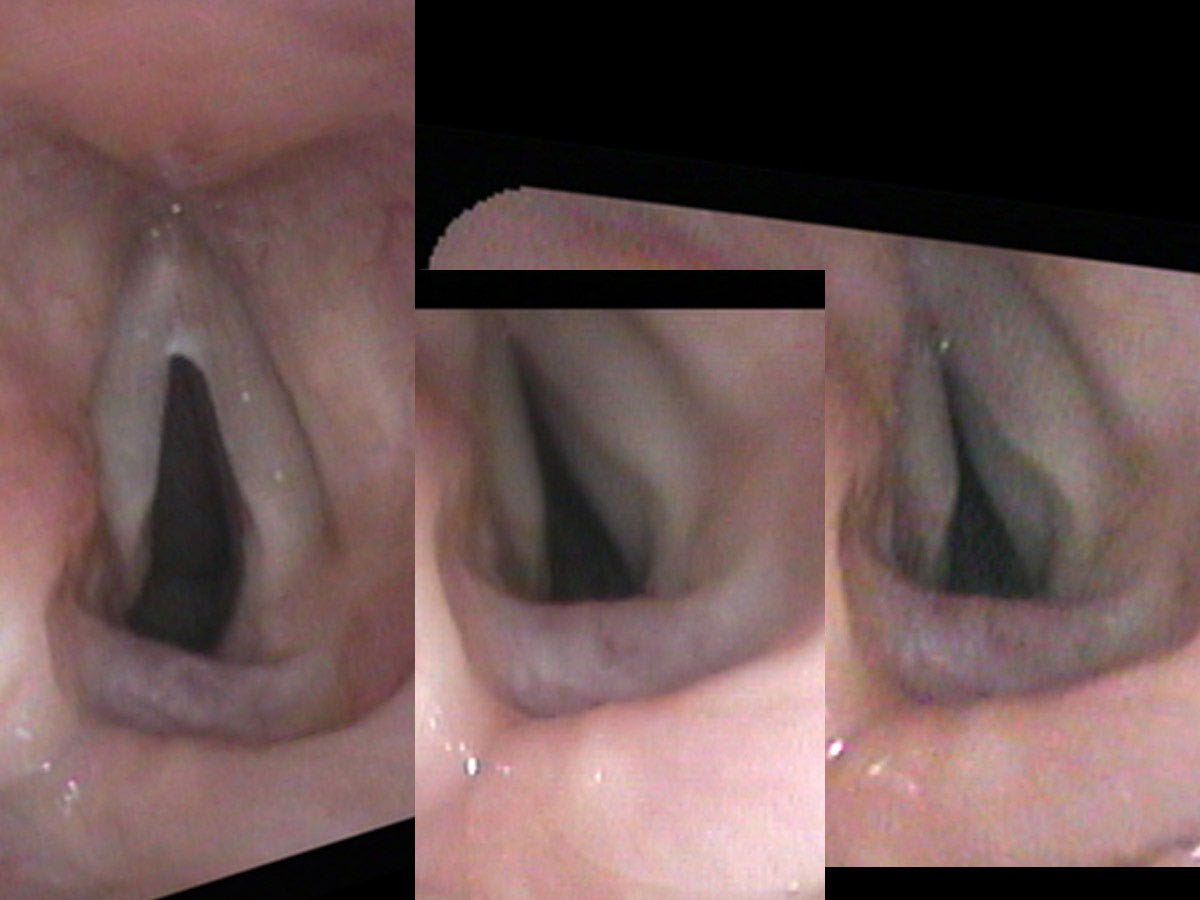 Three endoscopic views showing progressive hyperadduction of the left vocal cord